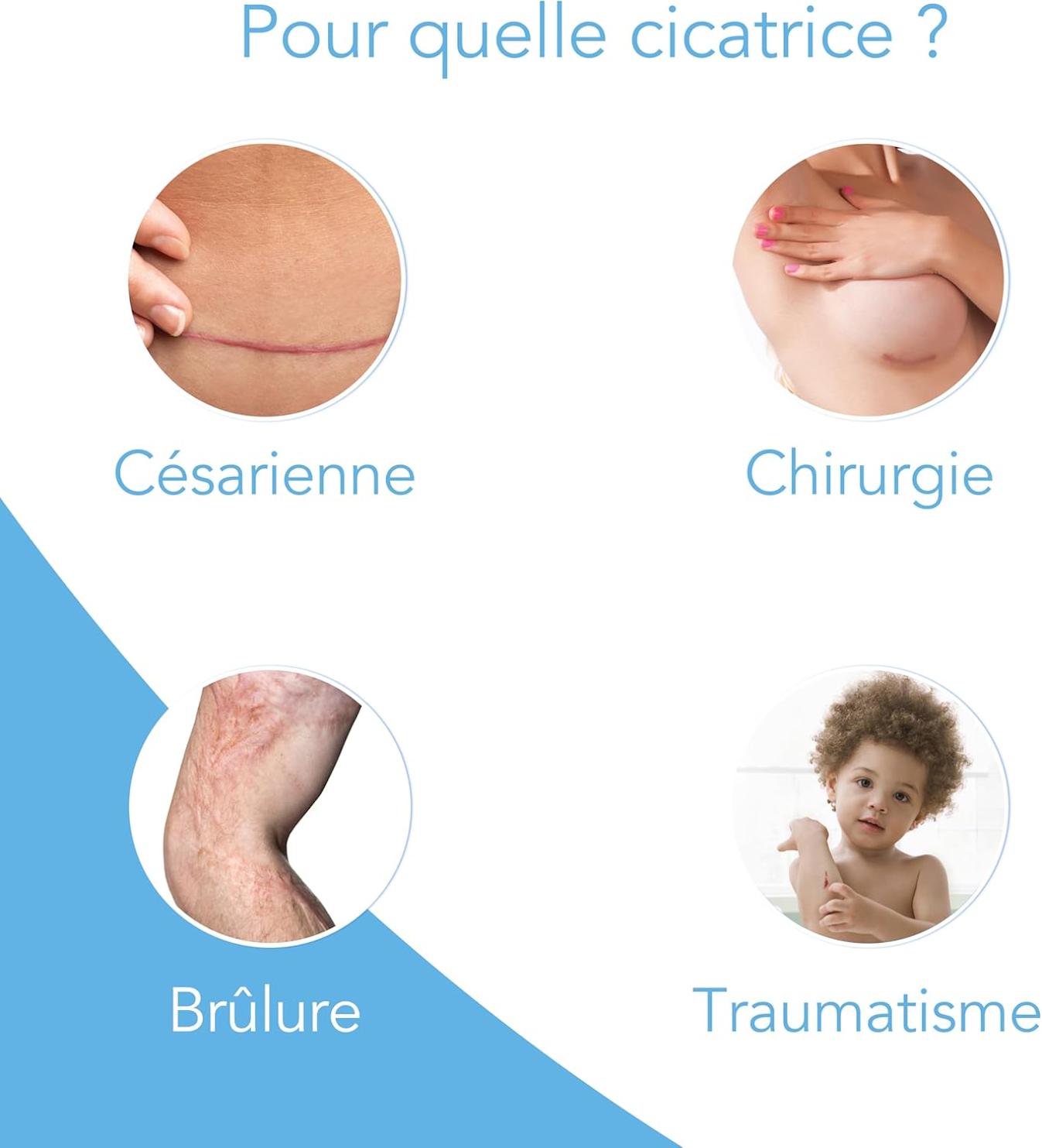 Gel Pour Cicatrices Silicone Kelocote.