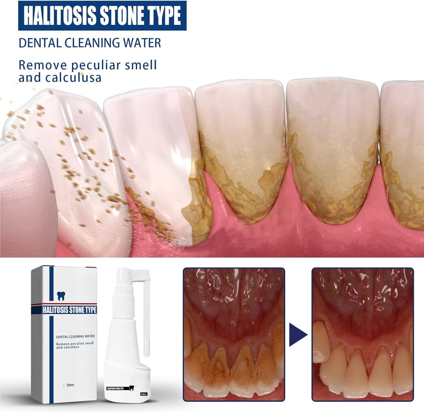 Spray de Nettoyage de Calcul Dentaire.