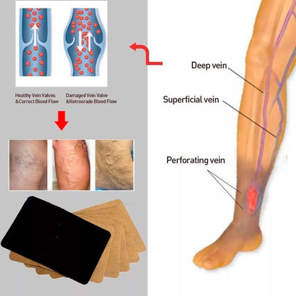 6 patchs pour éliminer les varices.
