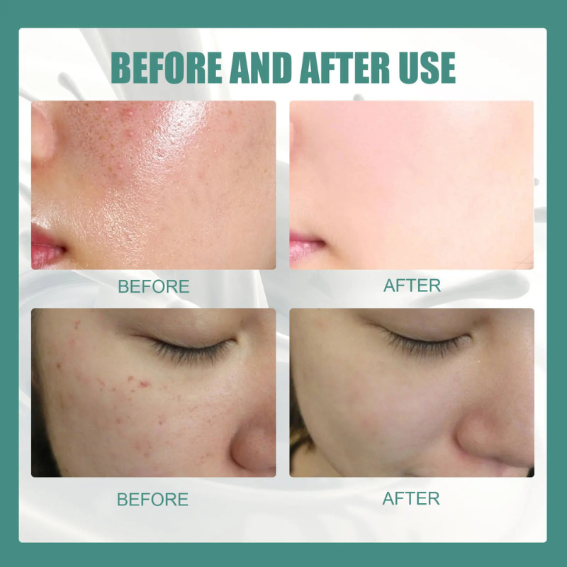 Savon Au Lait De Chèvre Blanchissant Et Nettoyant Acné .