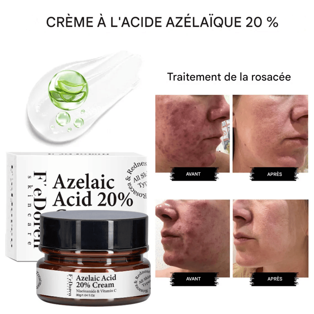 Dites adieu aux boutons et aux taches avec la crème Azelaic Acid 20%