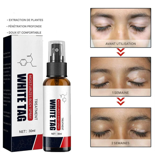 Spray Réparateur pour Vitiligo & Psoriasis.