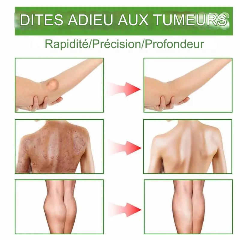 Crème d'élimination de lipomes