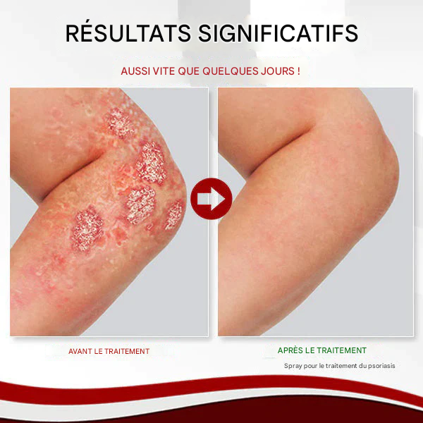 Spray Réparateur pour Vitiligo & Psoriasis.