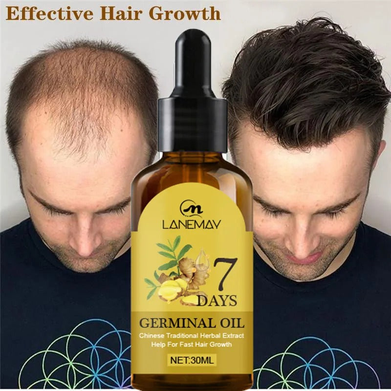 Huile de gingembre pour combattre la calvitie en 7 jours.